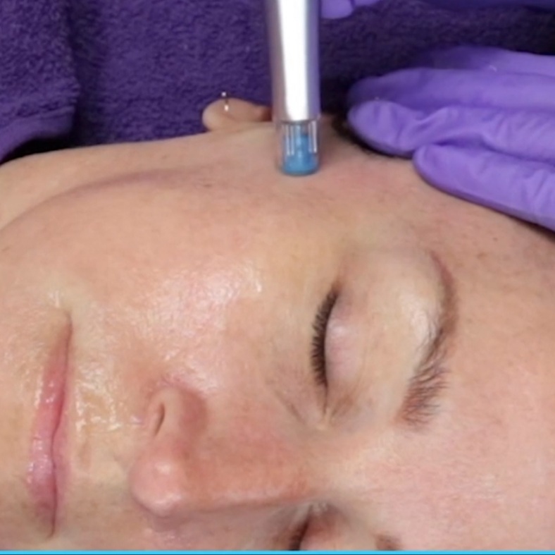 Micro Needling Facial