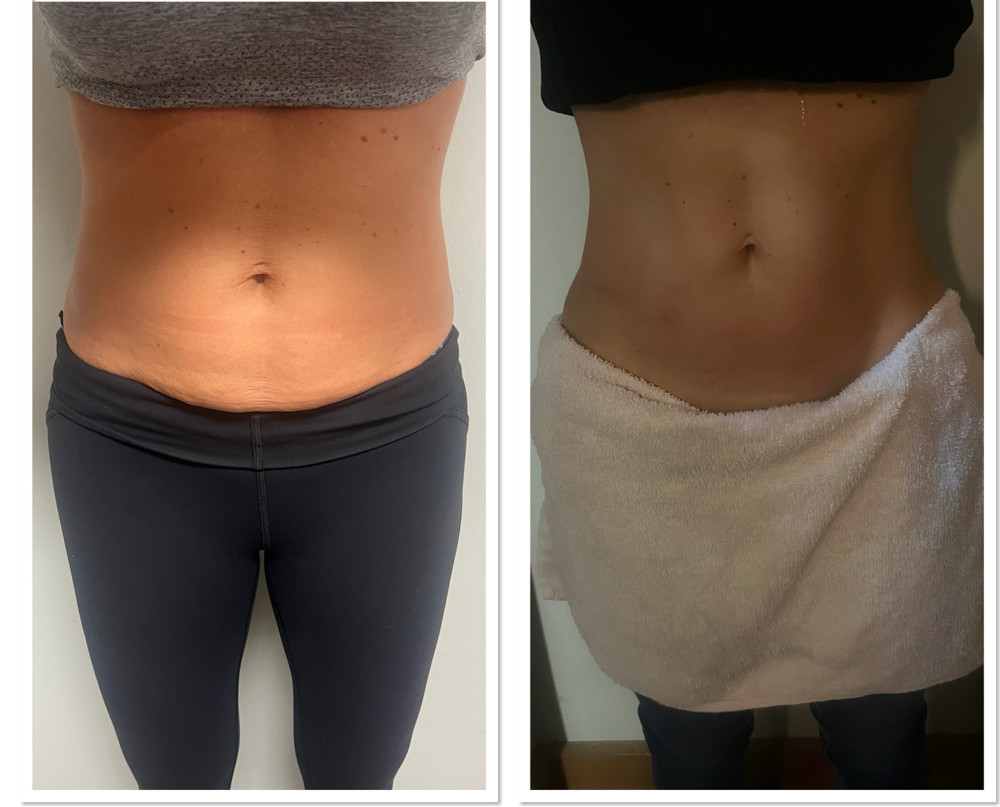 Skin Tightening BUNDLE (4 Treatmen)