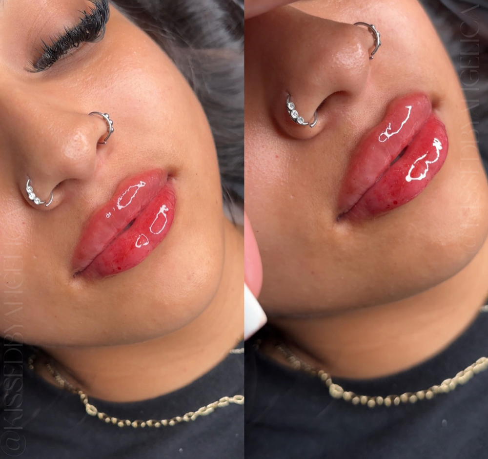 Micro Needle Lip Filler Course