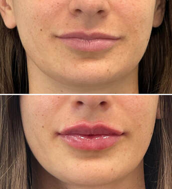 Lip Augmentation