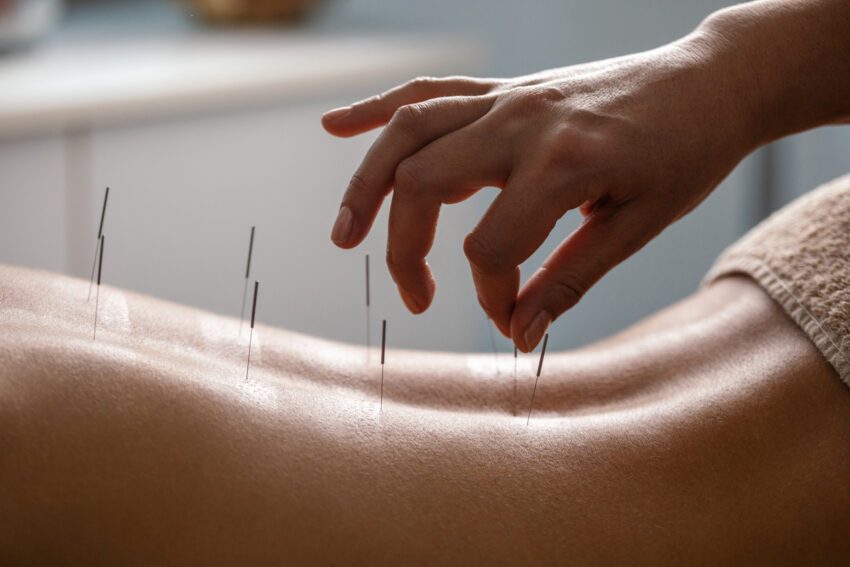Acupuncture Treatments