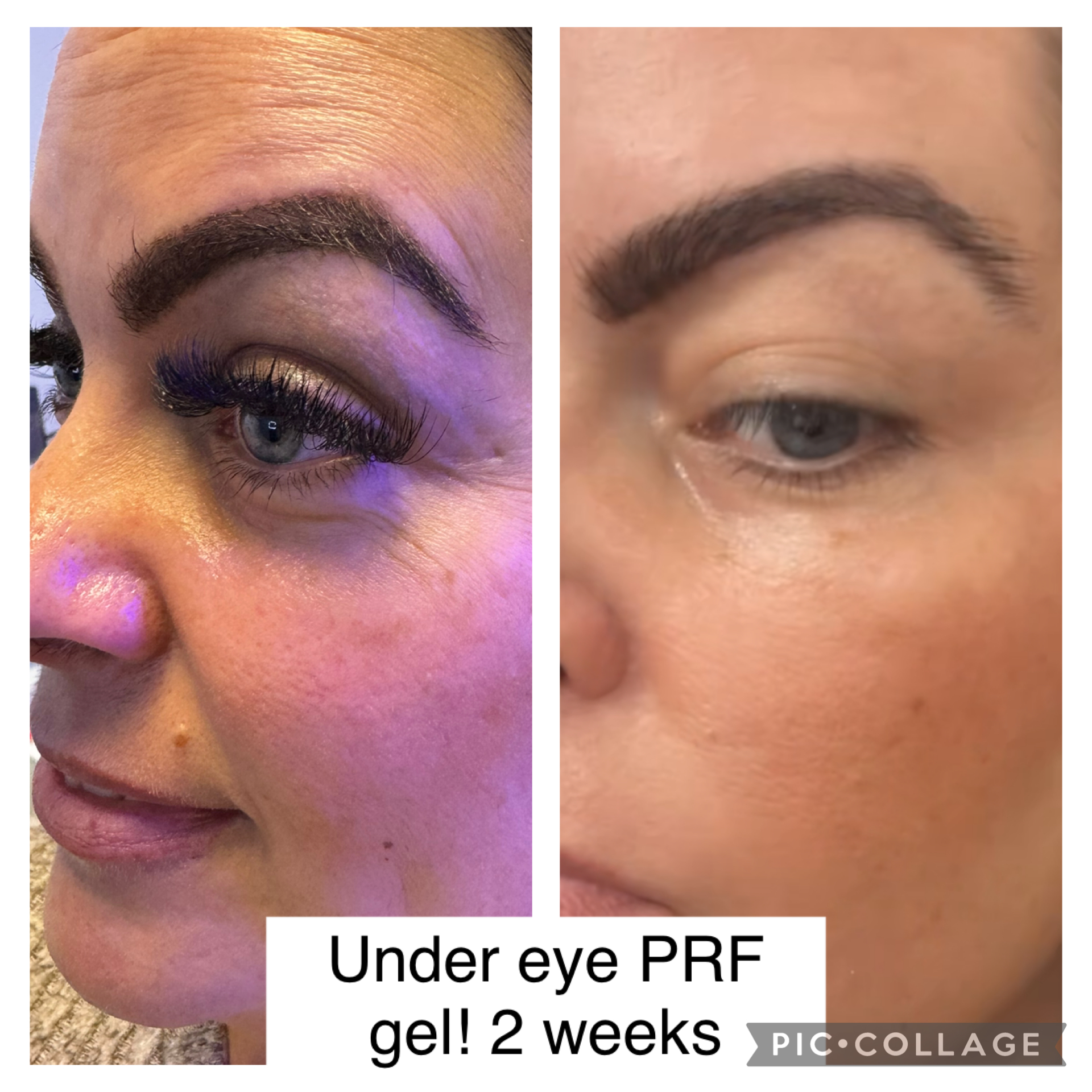 PRF GEL Under Eye Injections