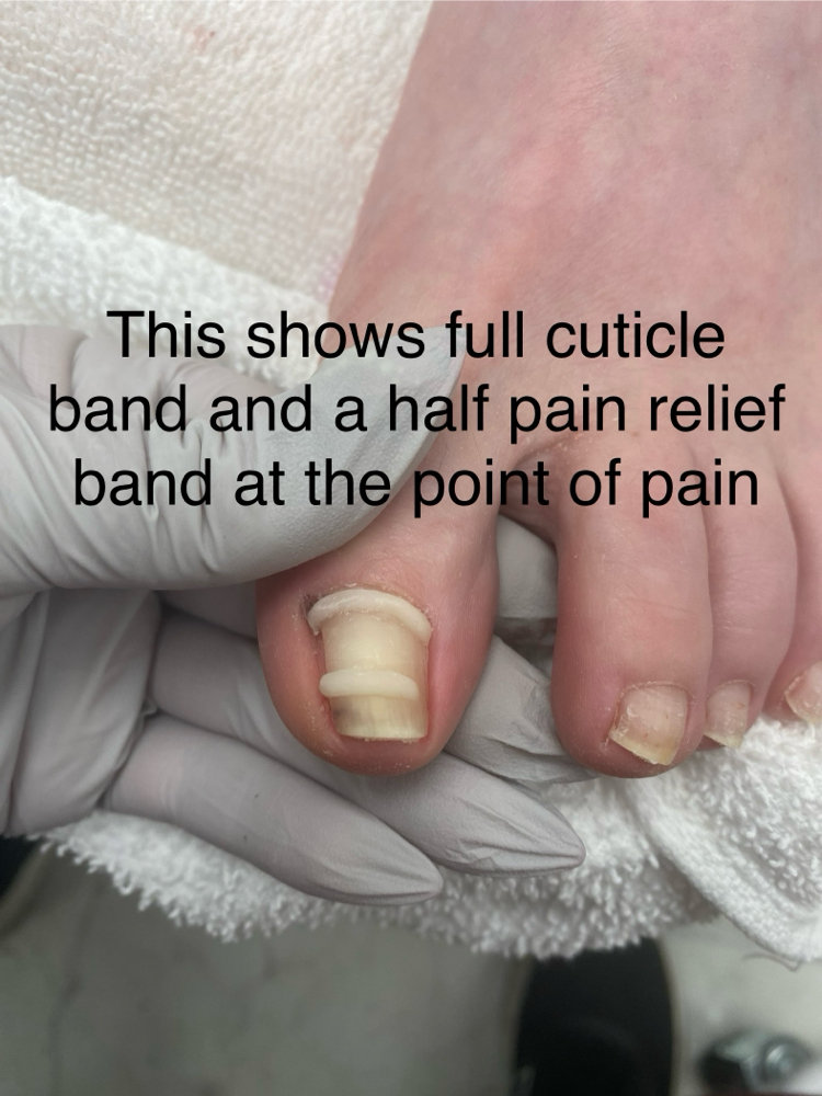 Onyfix Ingrown Correction