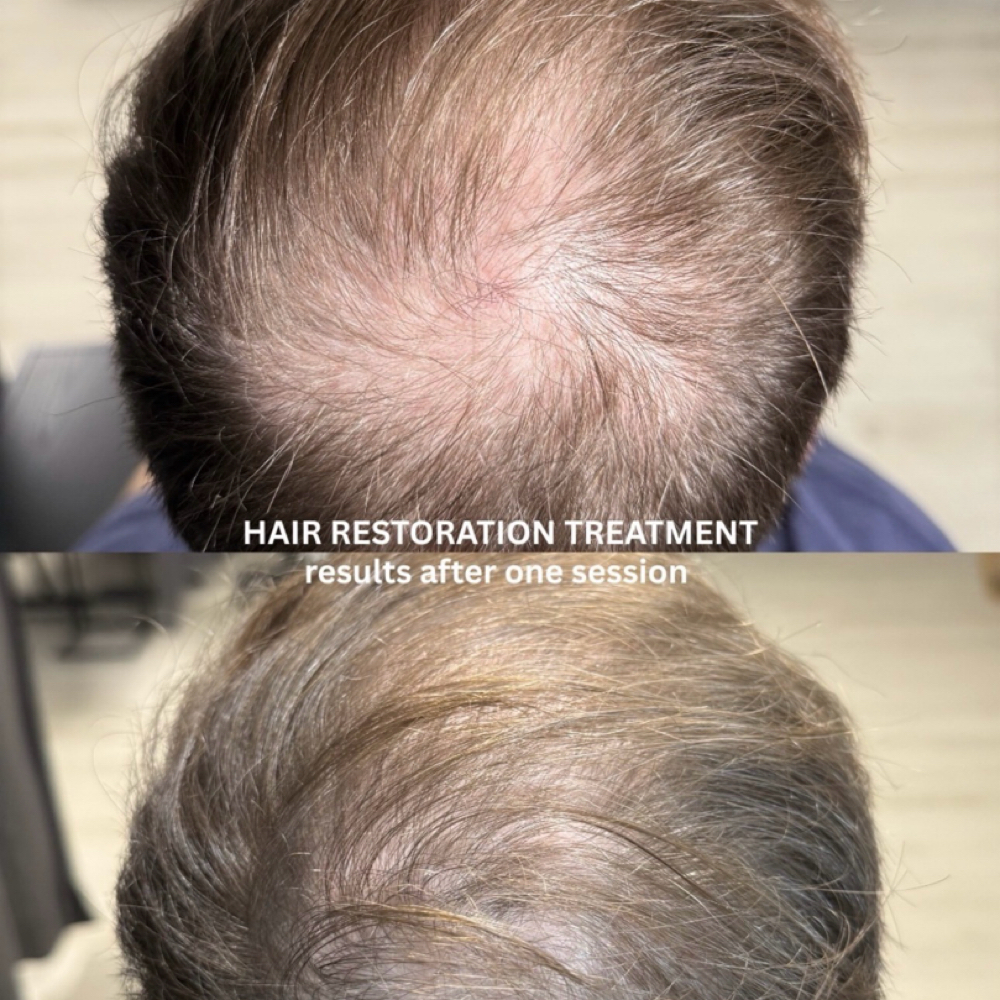 NUE Hair Growth Treatment at Stylisée Microblading in Chicago, IL