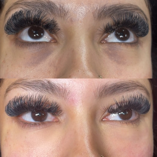 PRF Undereyes/EZ Gel at Viv Aesthetics & Wellness in San Antonio, TX