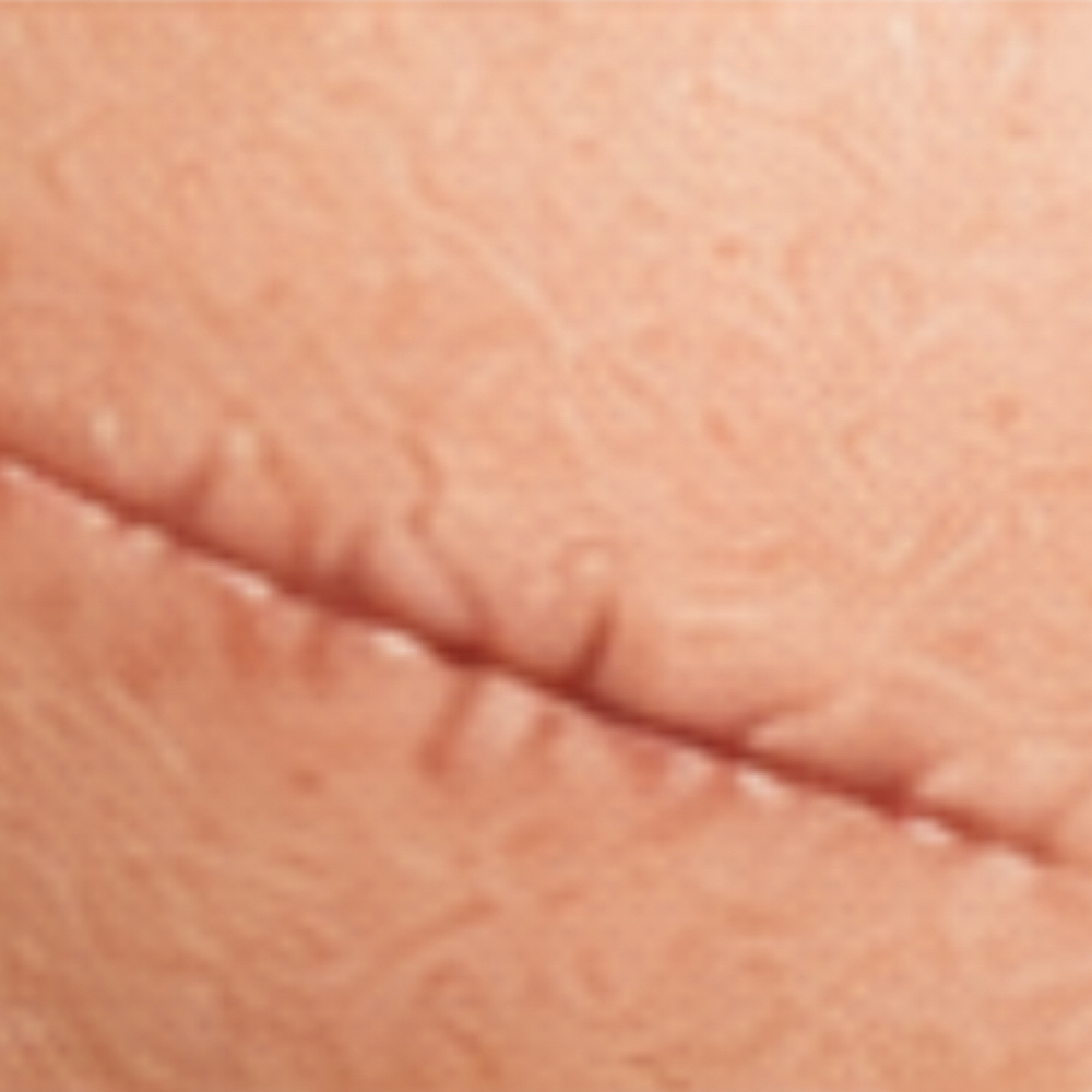 Scar Revision at Plasmalift Skin Clinic LLC in Bettendorf, IA