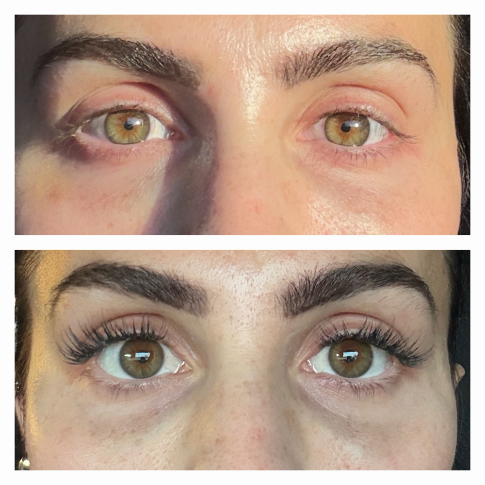 Tear Trough Fillers at Atelier Aesthetics and Infusions in Dallas, TX