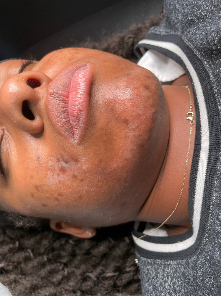 First Time Chemical Peel