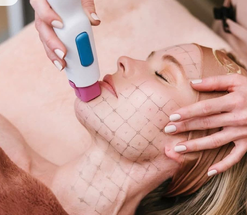 THERMAGE FLX at Faces by DeAngela in New Brockton, AL
