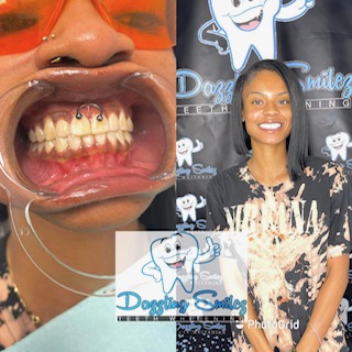 Extreme Teeth Whitening Session at Dazzling Smilez Teeth Whitening in Warner Robins, GA