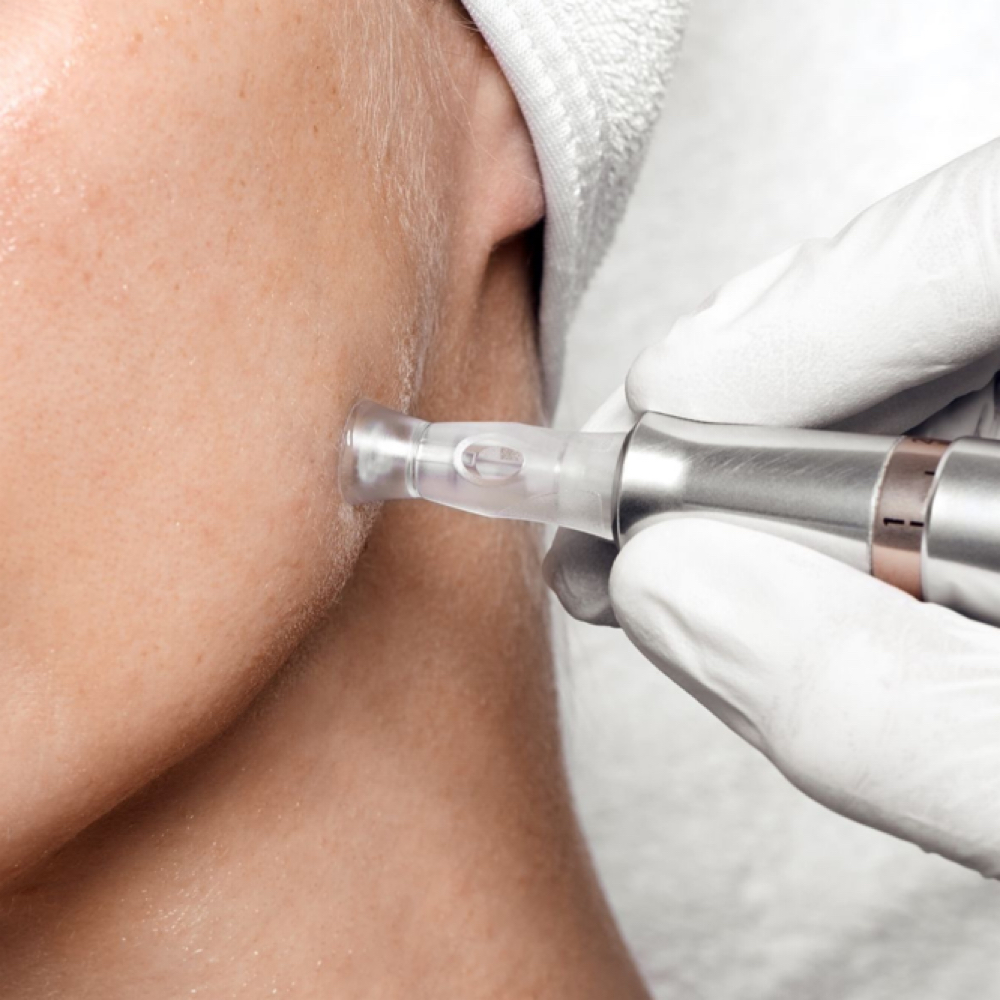 Microneedling (Face Only) at Magnolia Artistry in Draper, UT