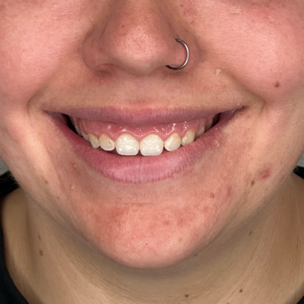 Gummy Smile at SCL Aesthetics in Putnam, CT