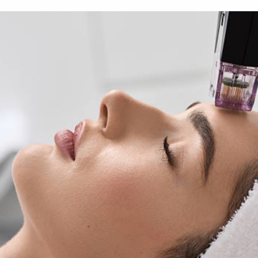 RF Microneedling at Unique U in Port Charlotte, FL