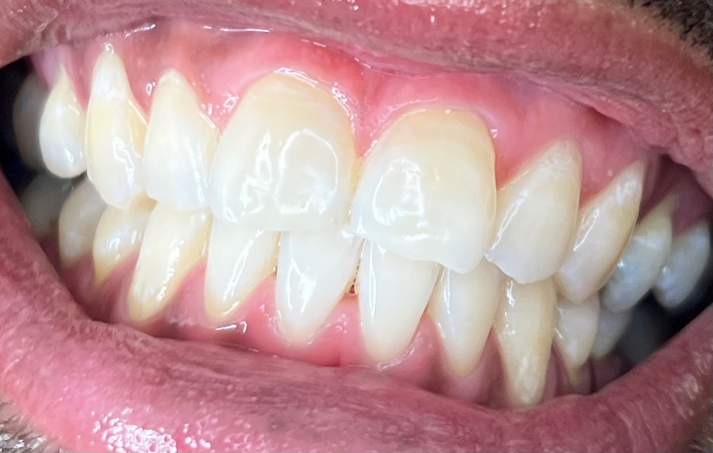 Tooth Gem Removal