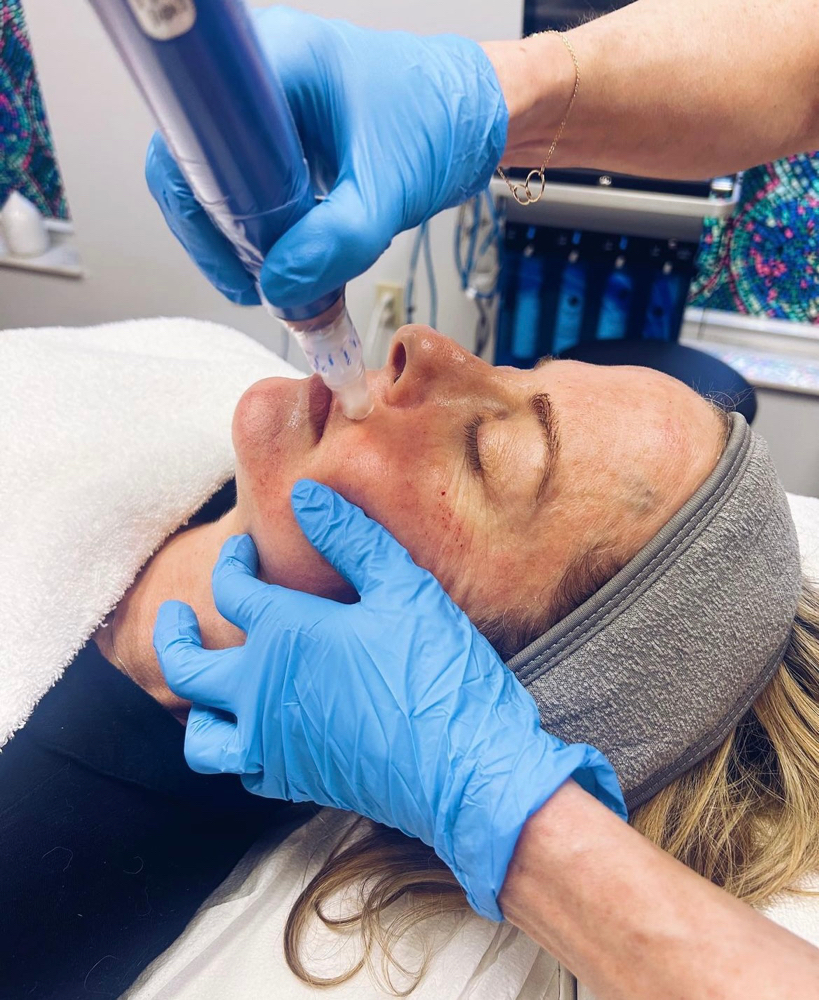 SkinPen Microneedling