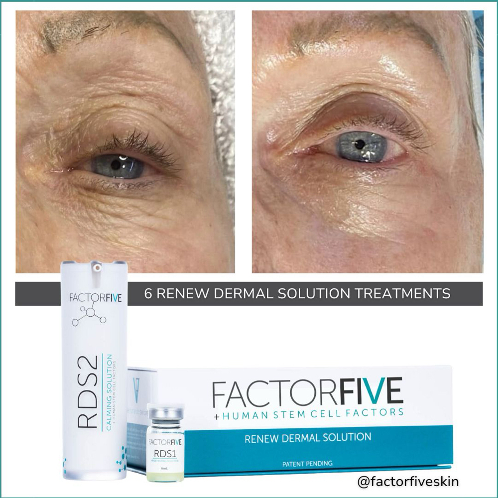 Factor Five- Renewal Dermal Peel at Inner Beauty by Esther in Albany, OR