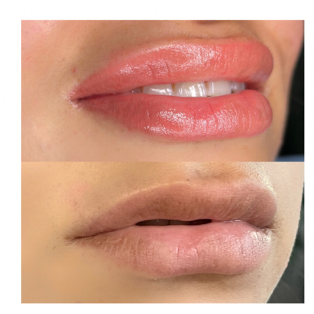 Lip Neutralization at Golden Kiss Aesthetics in Sewell, NJ