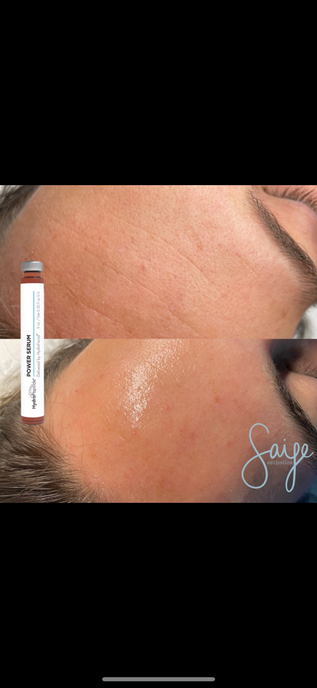 Hydrafacial (Face/Neck/Chest)