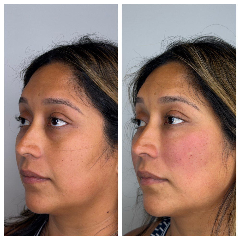 Derma PRP at SCL Aesthetics in Putnam, CT
