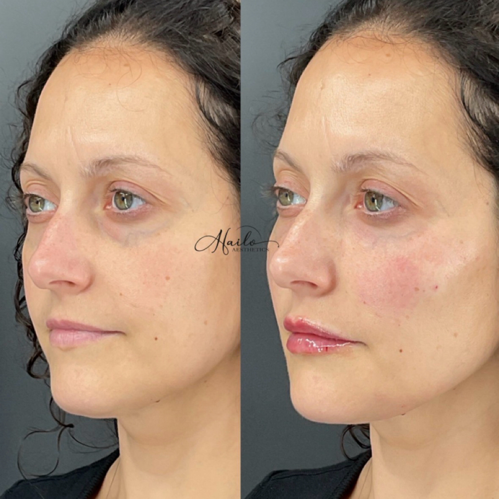 Derma PRP at SCL Aesthetics in Putnam, CT