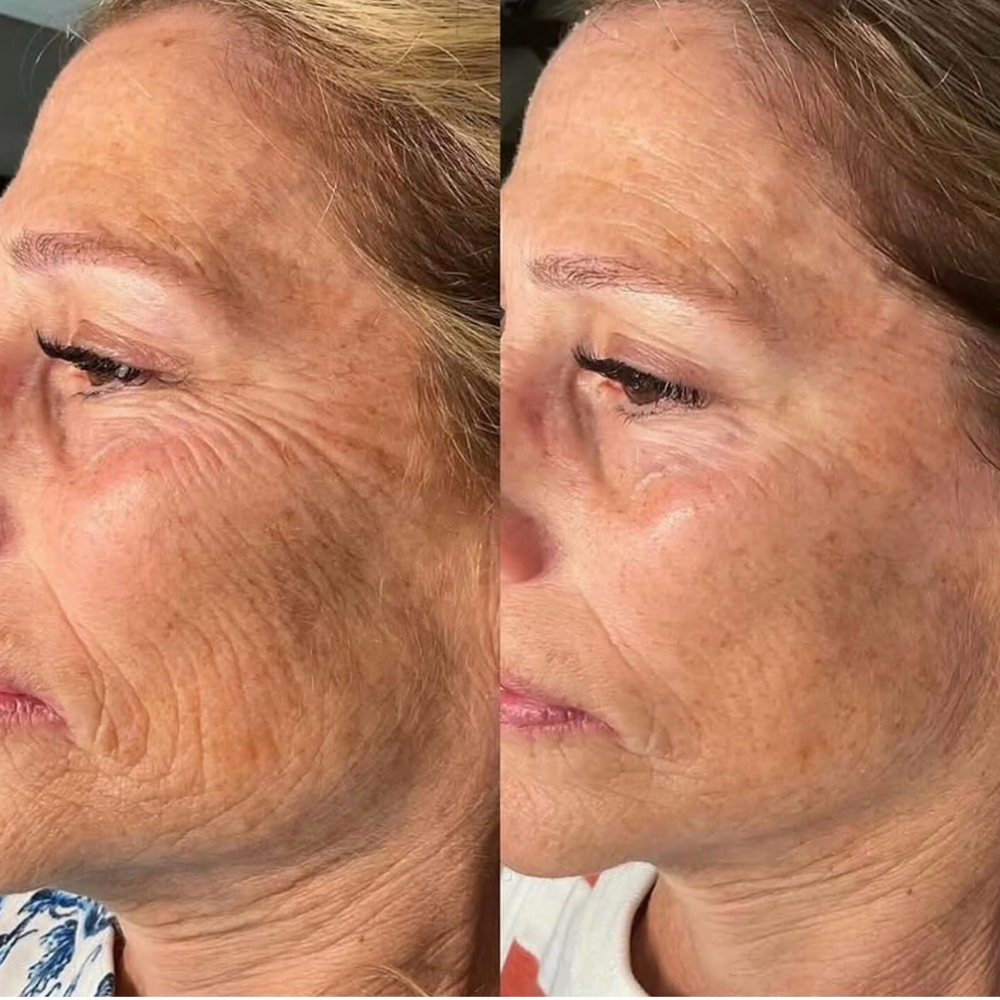 PRX Derm Perfection – Face & Neck at Marco Island Aesthetics in Marco Island,, FL