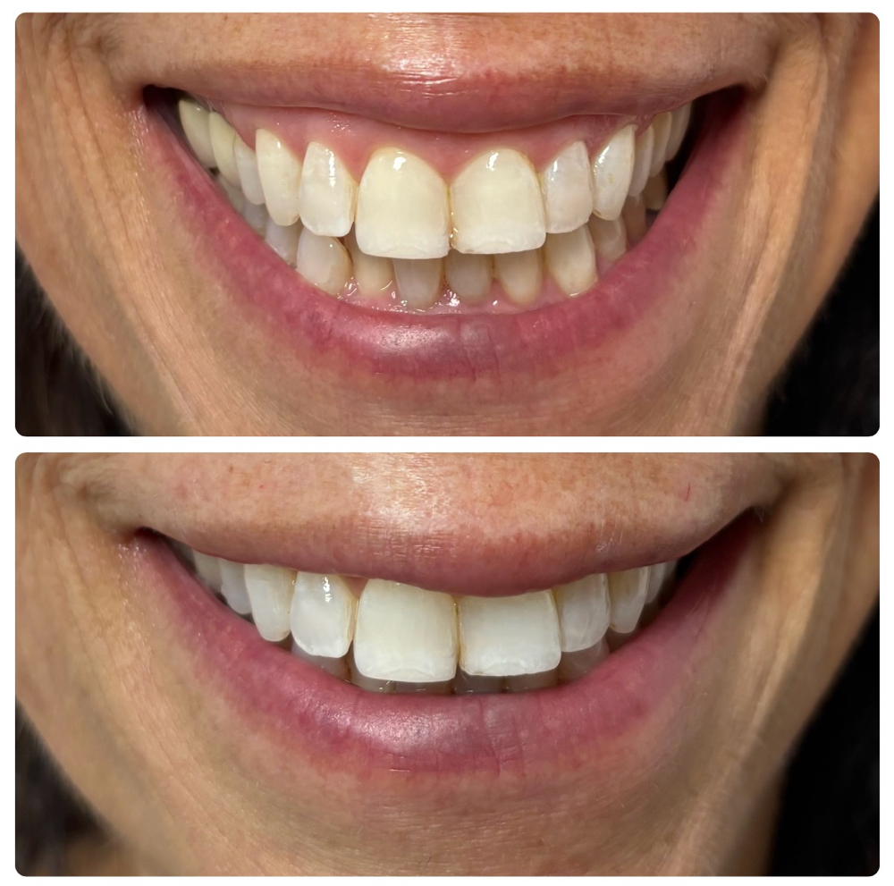 Gummy Smile Correction Tox