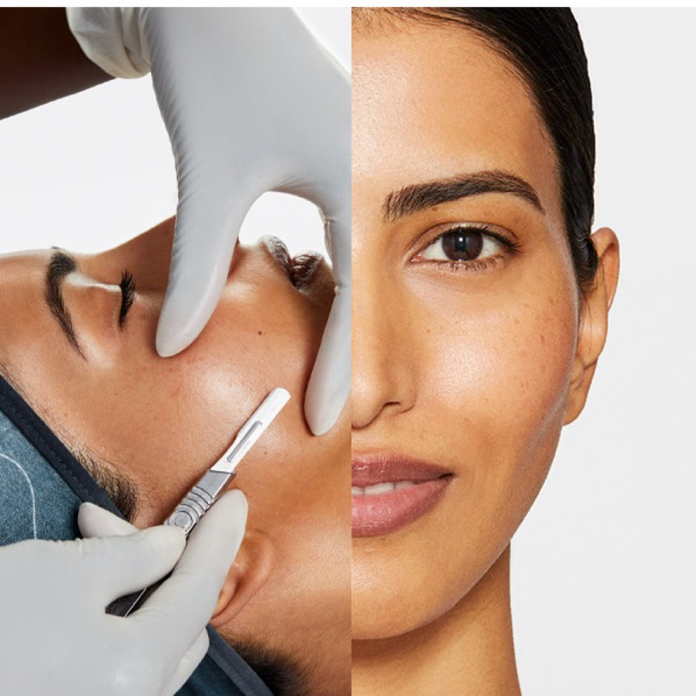 Dermaplaning Add-On at A&A POREFECTION in Amherst, NY