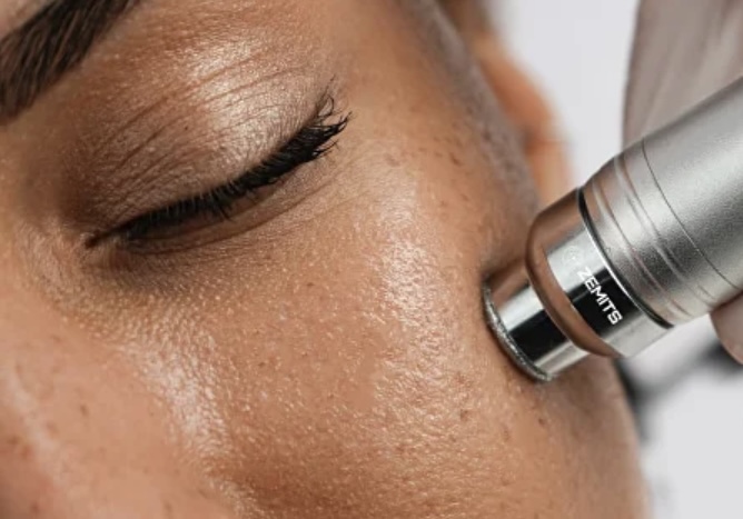 HydroDiamond and Microdermabrasion