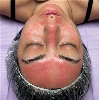 Microneedling (Collagen Induction)