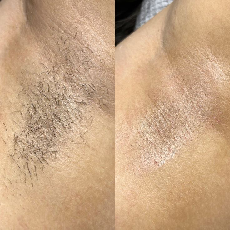 Underarm Waxing