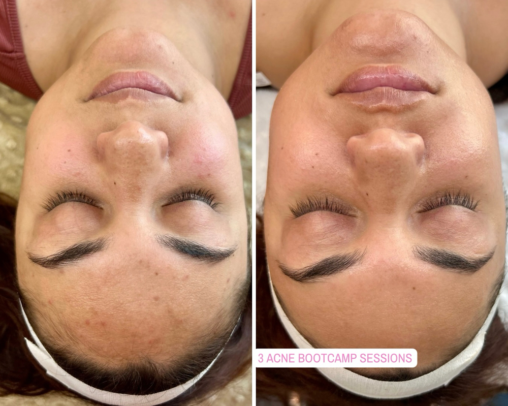 Acne Bootcamp 30