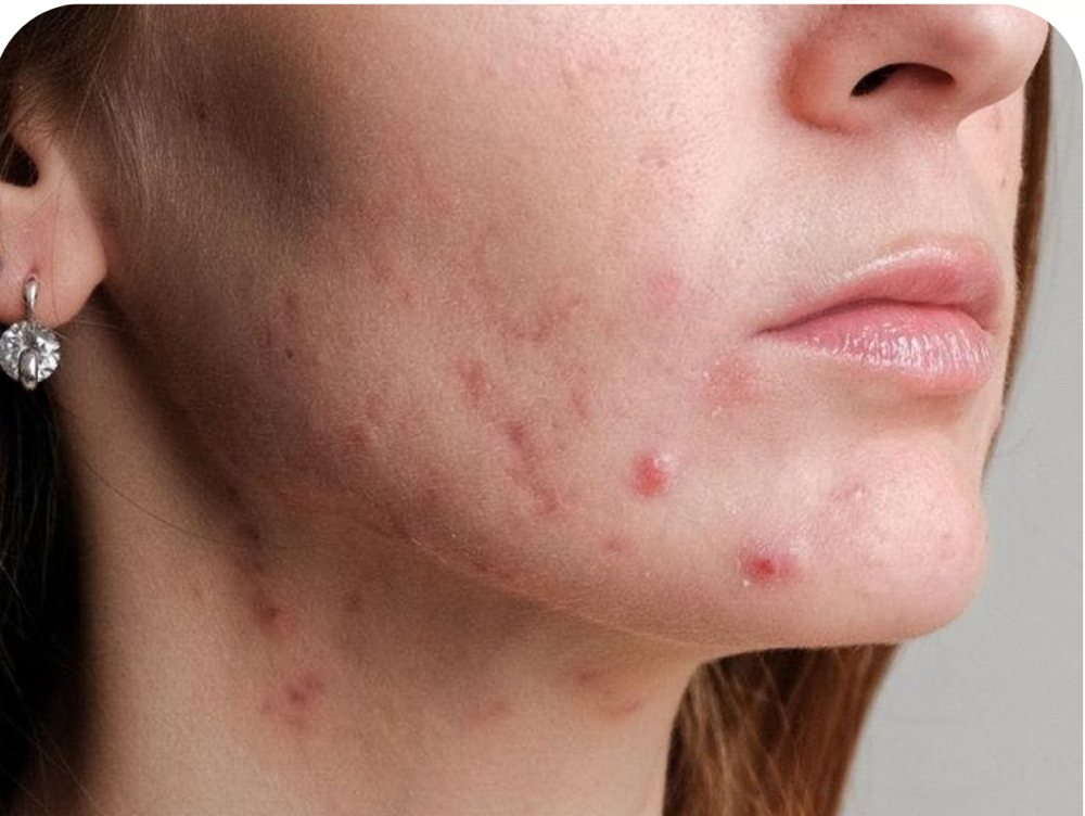 Acne Treatment