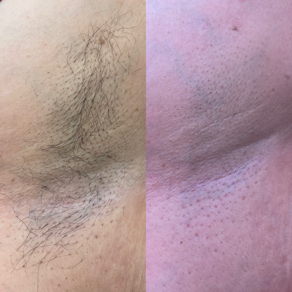 Underarm Wax