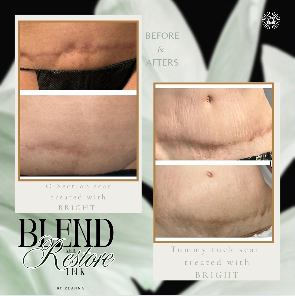 Tummy Tuck 360°