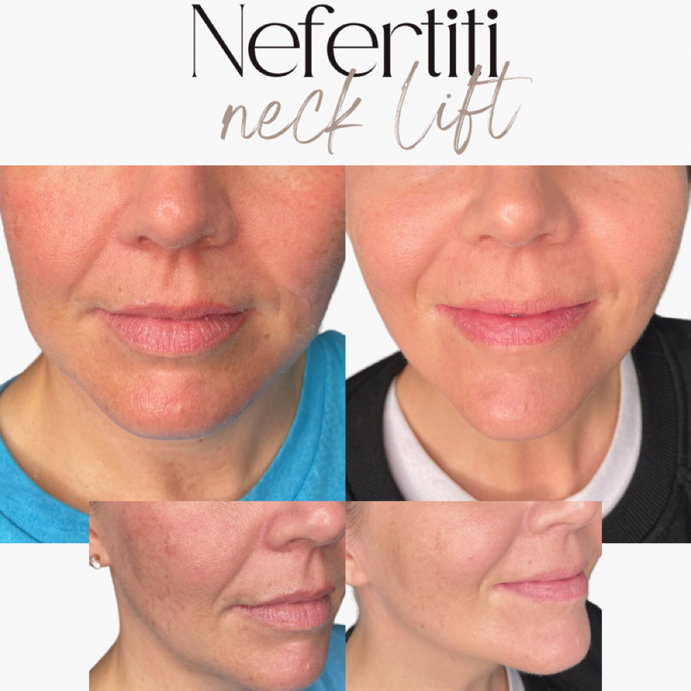 Nefertit Neck Lift at Alluring Soul in Joplin, MO