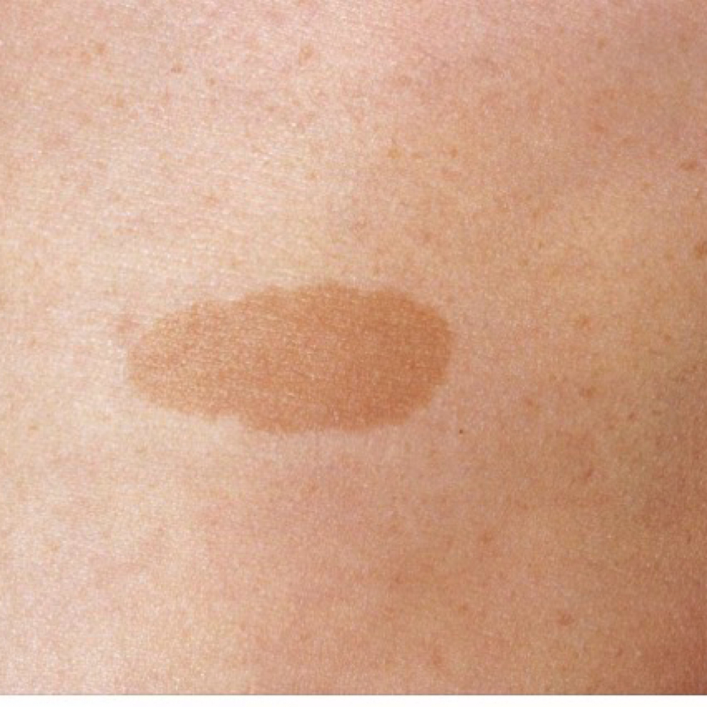 Birthmarks (3) at La Belle Studio by Soraya in Woburn, MA