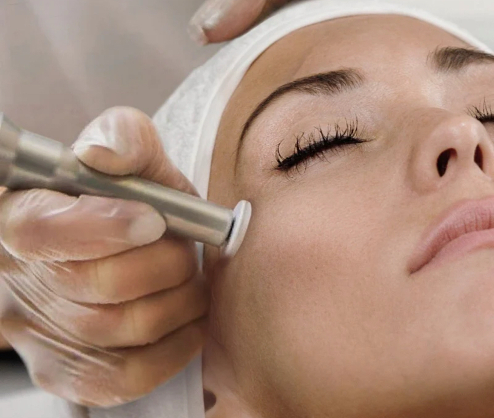 Microchanneling-Needling Session