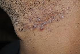 Ingrown Hair Treatment- Neck