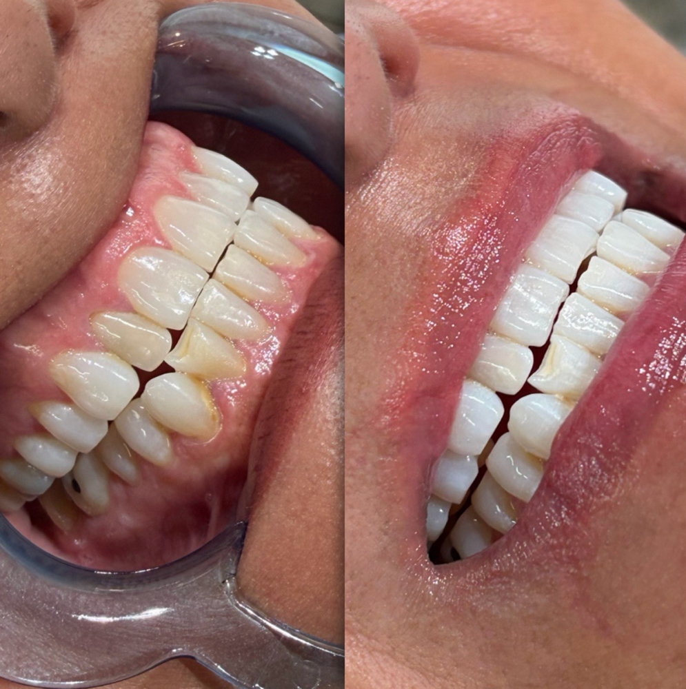 Teeth Whitening 1 hour session at Waxed Culture in Olmos Park, TX