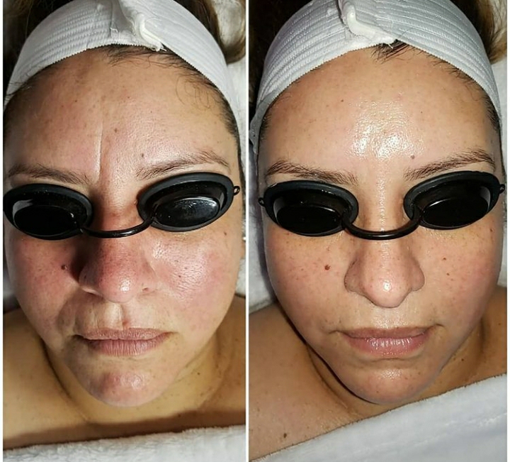 The BOTOX Facial