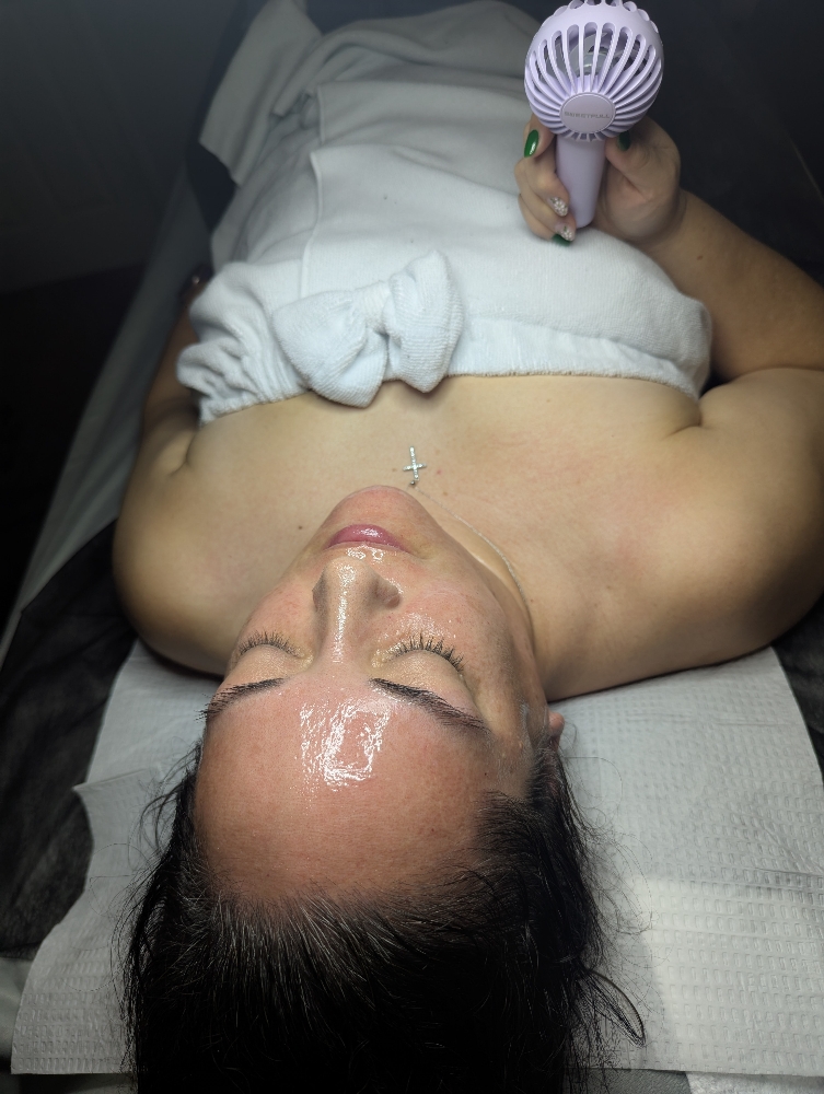 Chemical Peel