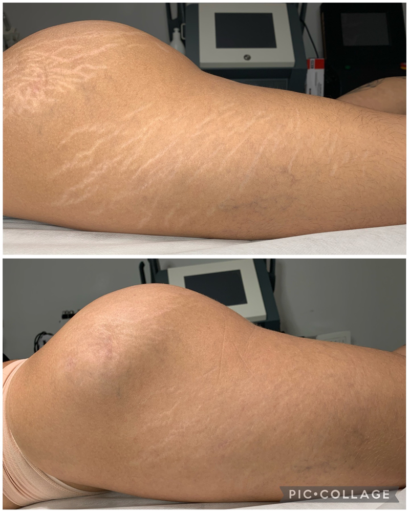 Stretch Marks Treatment