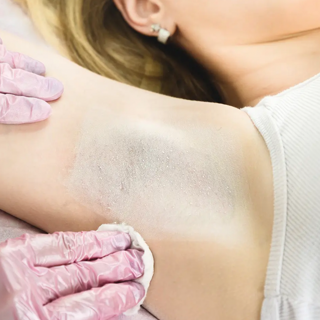 Anal or Underarm Bleaching at Trale Beauty in Lewisville, TX