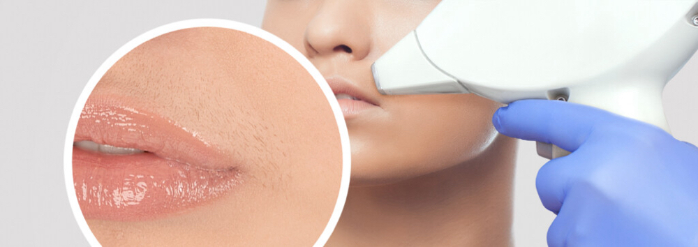 Upper lip IPL hair removal