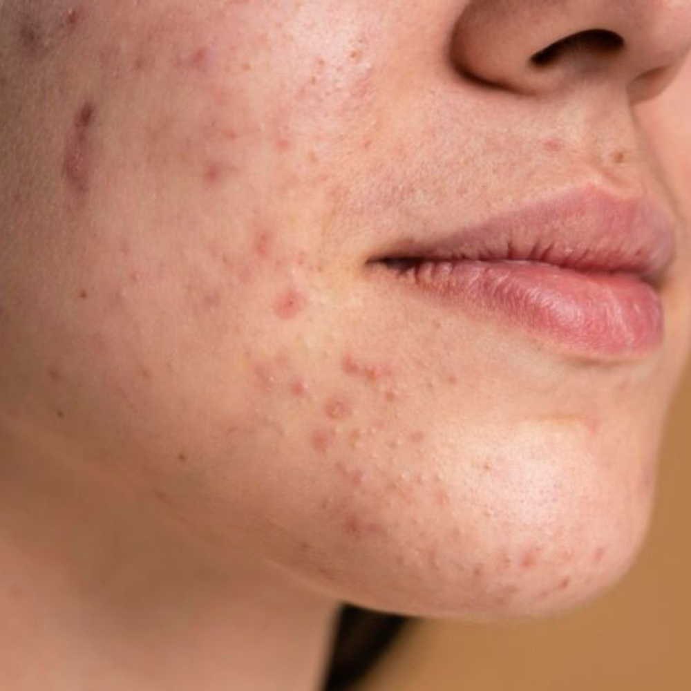 Acne Facial