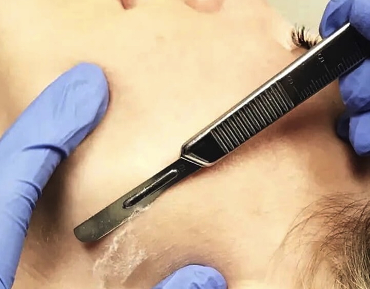 Renewal Dermaplane Facial at Primal Esthetics & Wellness in Siloam Springs, AR