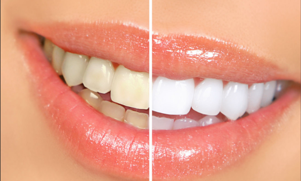 Teeth Whitening