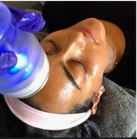 Follow Up CRYO Facelift