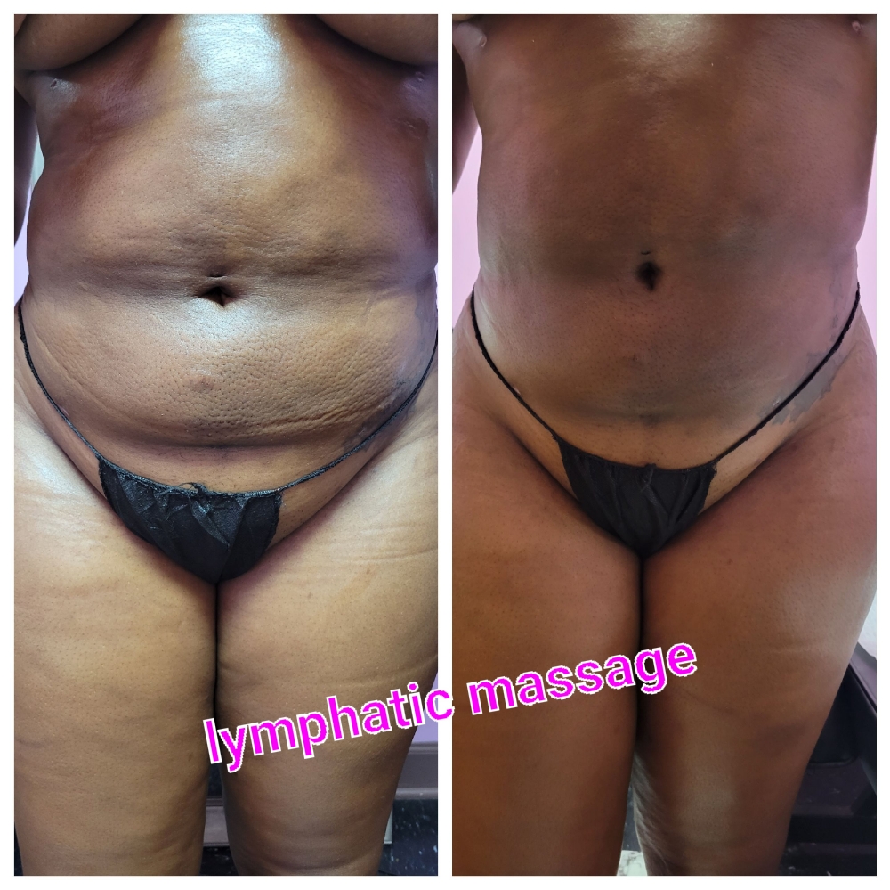Lymphatic Drainage Therapy