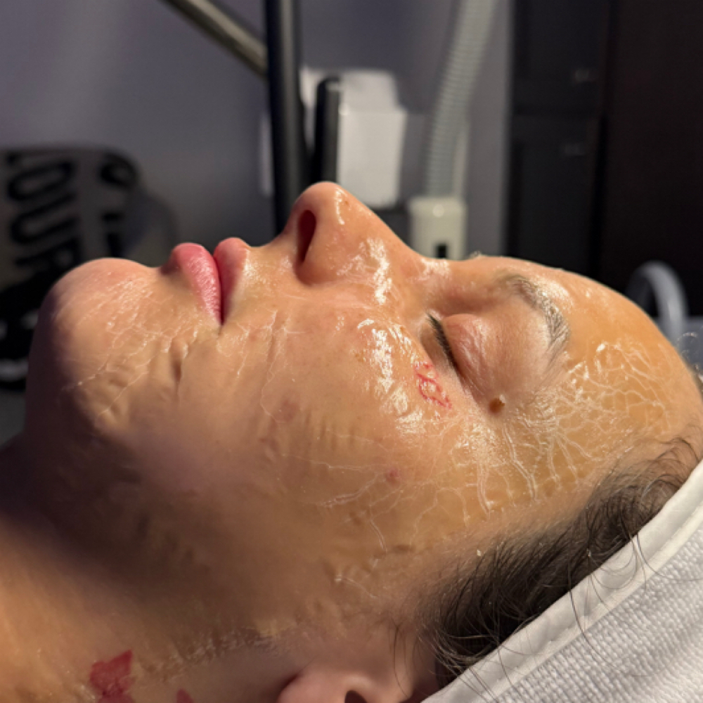 Tightening Facial